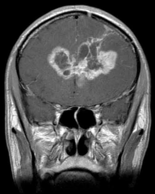 Brain Tumor CNN